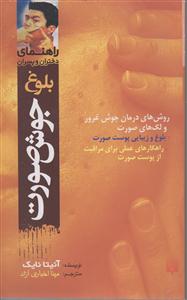 راهنمای دختران و پسران (جوش صورت)